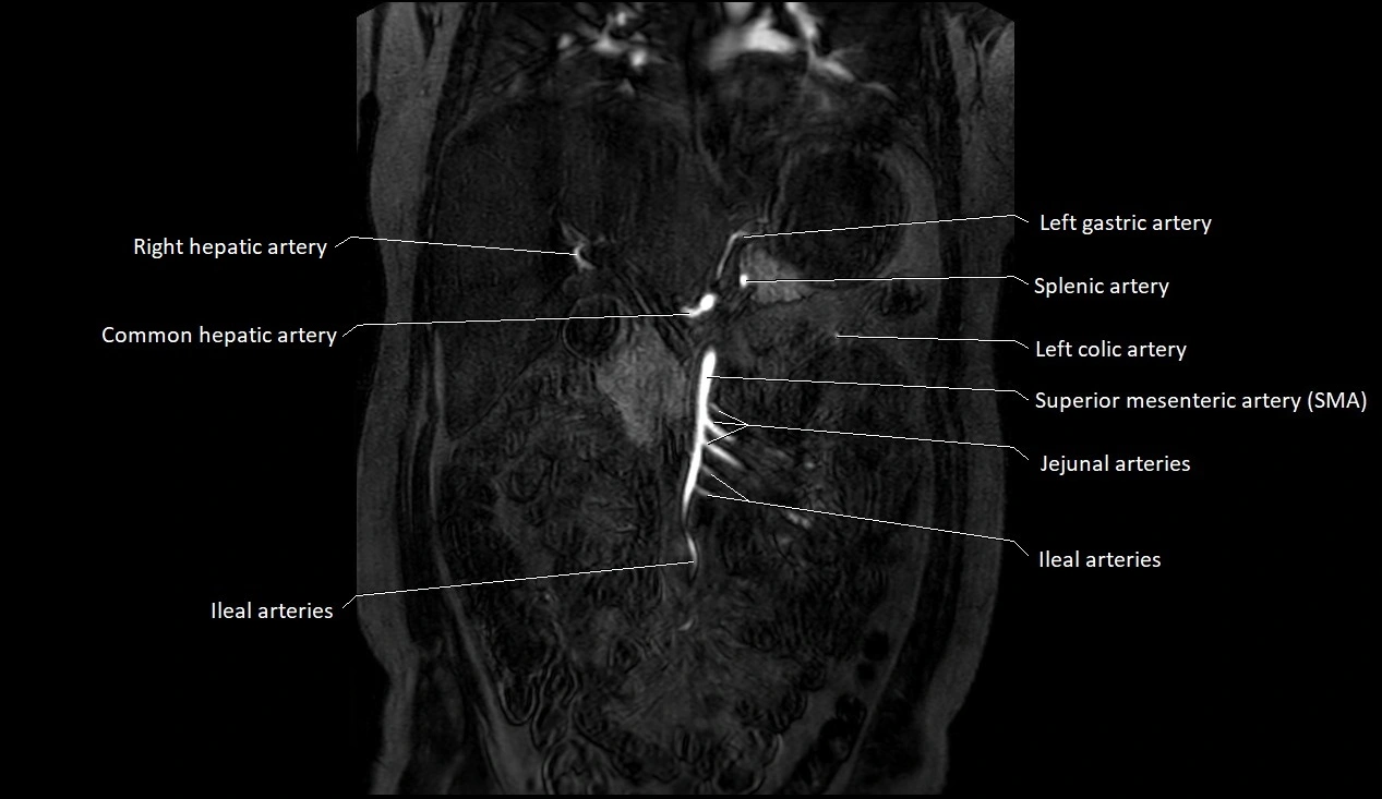 MRA Abdomen coronal anatomy image 8.webp